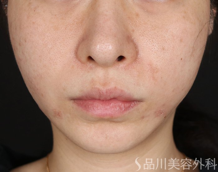 症例NO.71734のAFTER写真