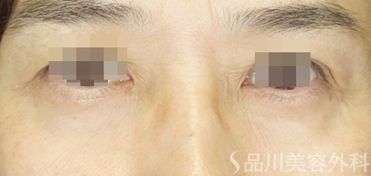 症例NO.71083のAFTER写真