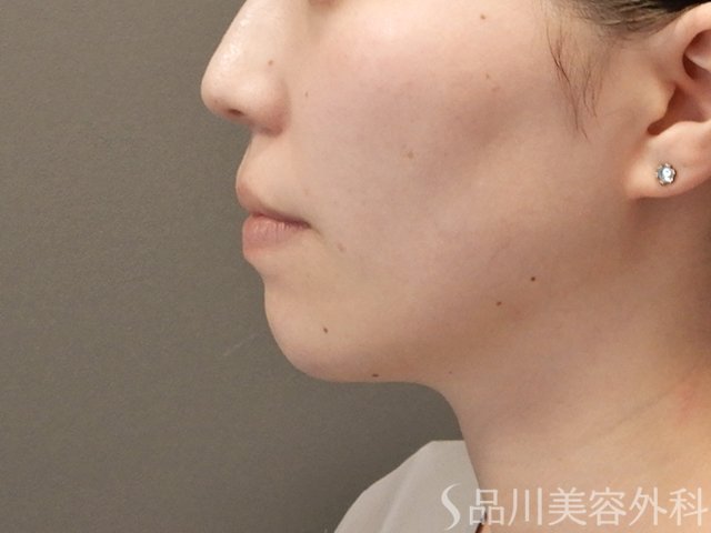 症例NO.74562のBEFORE写真