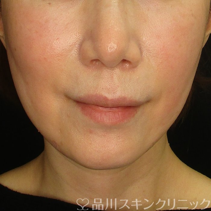 症例NO.72967のAFTER写真