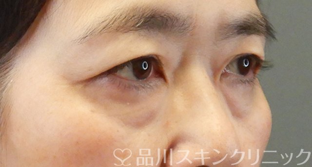 症例NO.67336のBEFORE写真