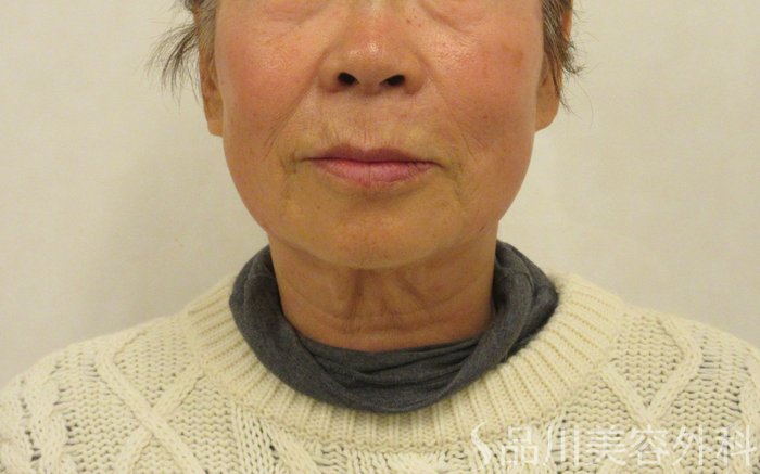 症例NO.72253のAFTER写真