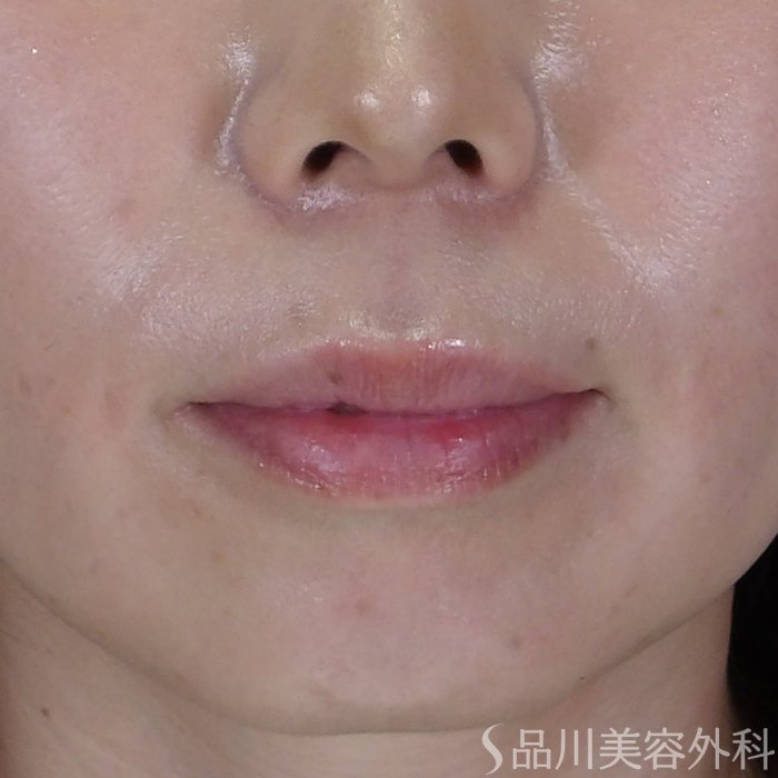 症例NO.71479のBEFORE写真