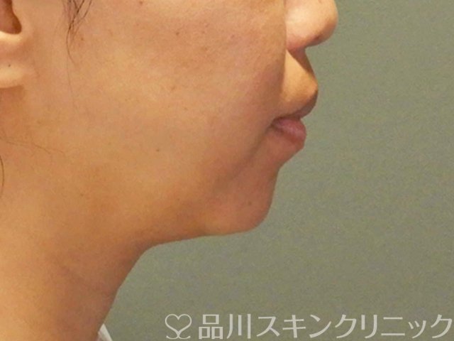 症例NO.66918のBEFORE写真