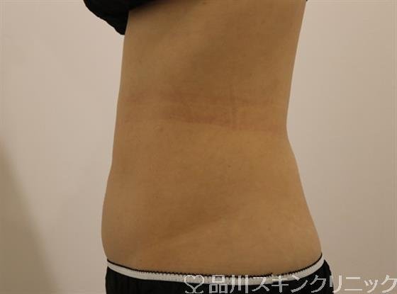 症例NO.43948のAFTER写真