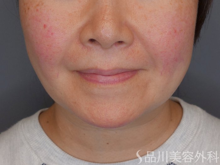 症例NO.70337のBEFORE写真