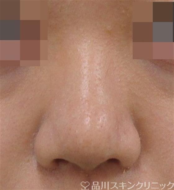 症例NO.40816のAFTER写真