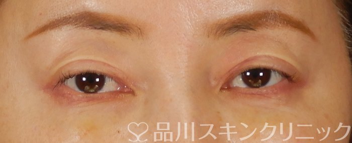 症例NO.65333のAFTER写真