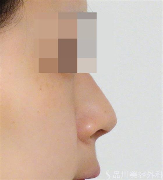 症例NO.42639のAFTER写真