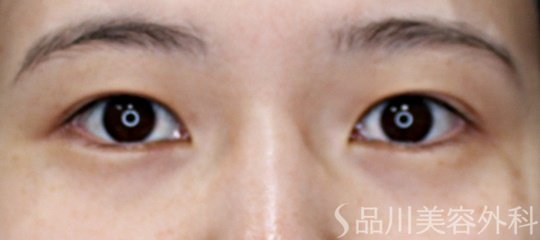 症例NO.67638のBEFORE写真