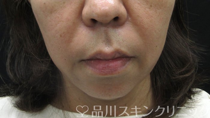 症例NO.70507のBEFORE写真