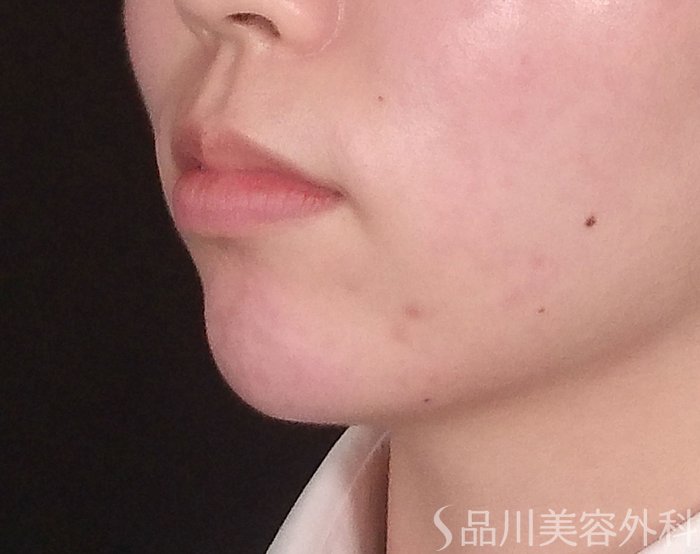 症例NO.70377のAFTER写真