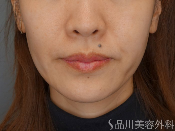 症例NO.72386のBEFORE写真