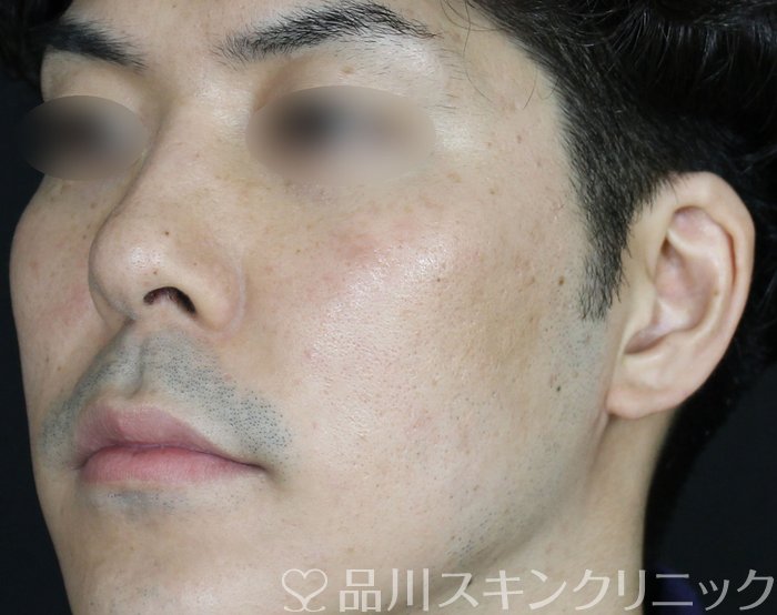 症例NO.69565のAFTER写真