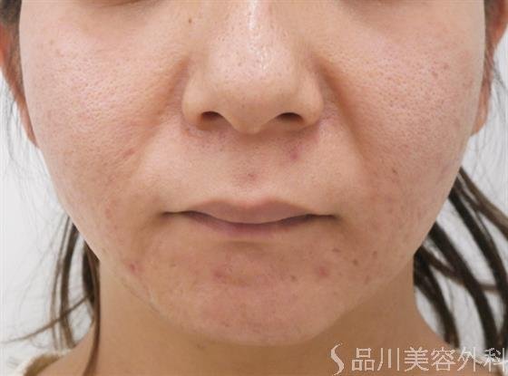 症例NO.28071のBEFORE写真