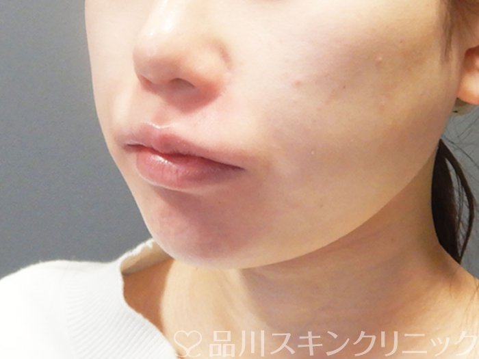 症例NO.73277のAFTER写真