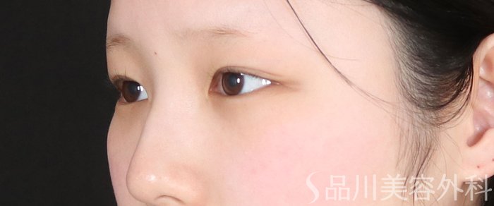 症例NO.73105のBEFORE写真