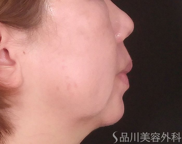 症例NO.70597のAFTER写真