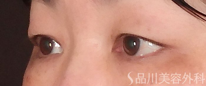 症例NO.70481のBEFORE写真