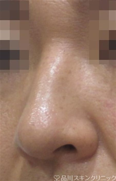 症例NO.35124のBEFORE写真