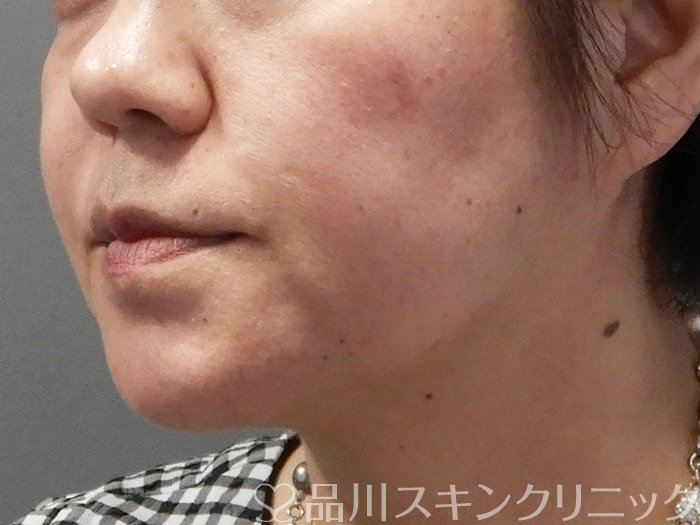 症例NO.71855のBEFORE写真