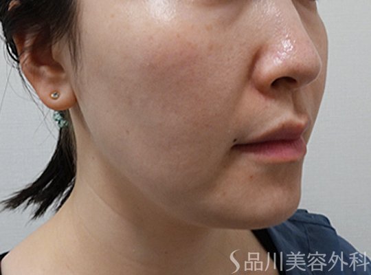 症例NO.75175のBEFORE写真