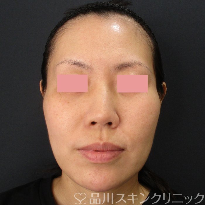 症例NO.71857のBEFORE写真