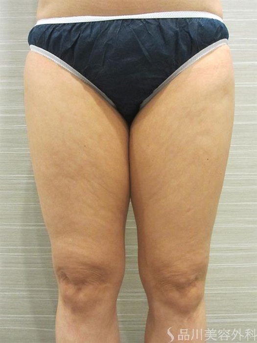 症例NO.23310のBEFORE写真