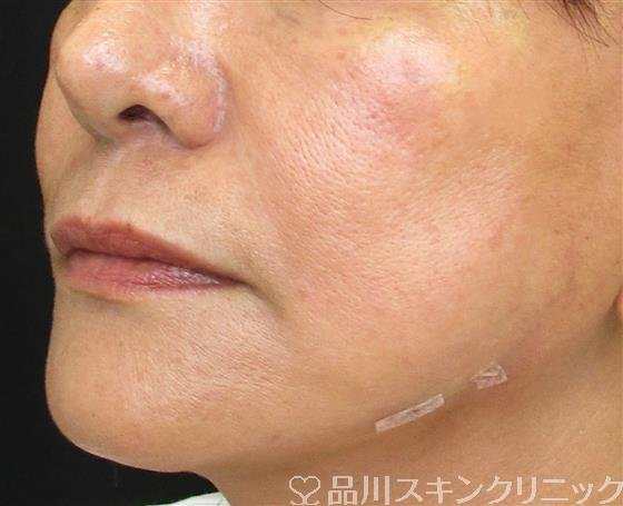 症例NO.56298のAFTER写真