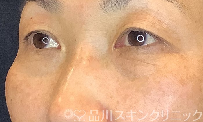症例NO.71160のBEFORE写真