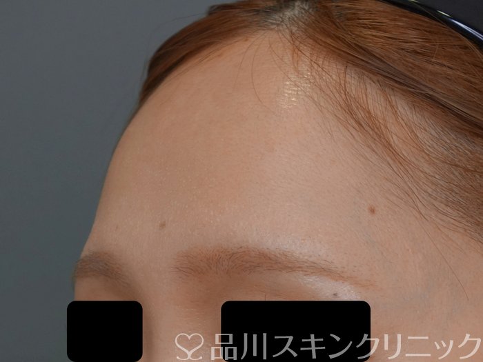 症例NO.71891のBEFORE写真