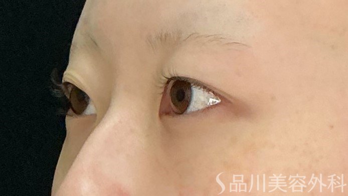 症例NO.71761のBEFORE写真