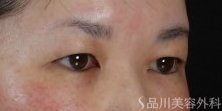 症例NO.74782のBEFORE写真