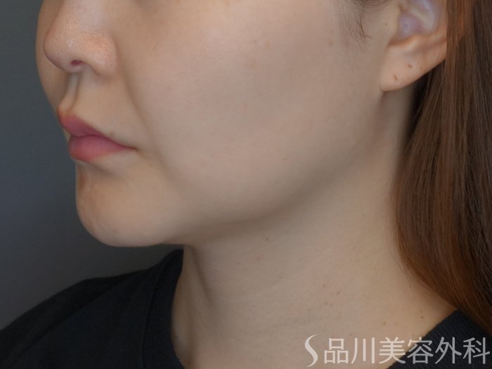 症例NO.70623のBEFORE写真