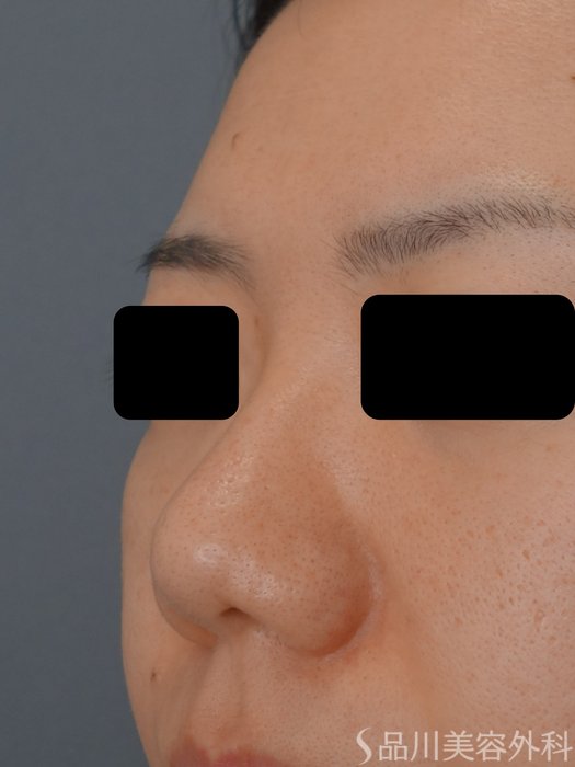 症例NO.74328のBEFORE写真