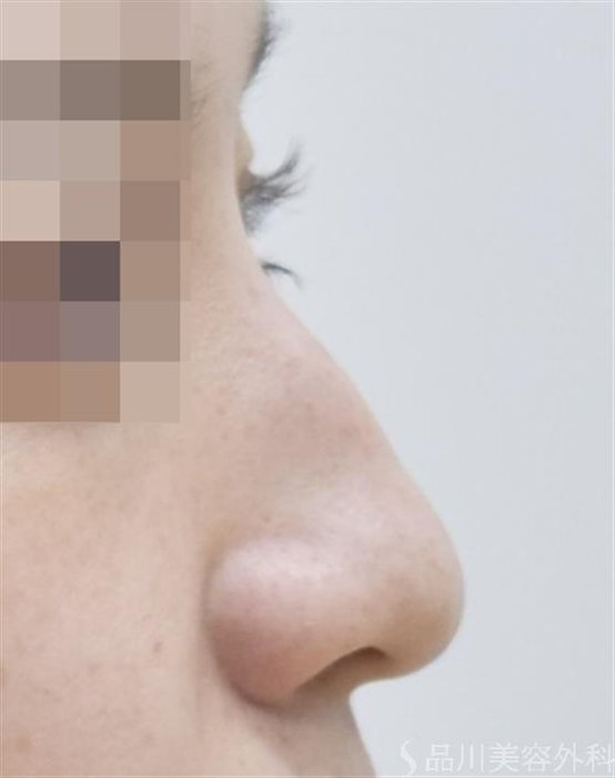 症例NO.51781のBEFORE写真