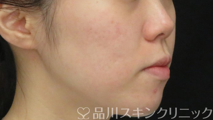 症例NO.71428のBEFORE写真