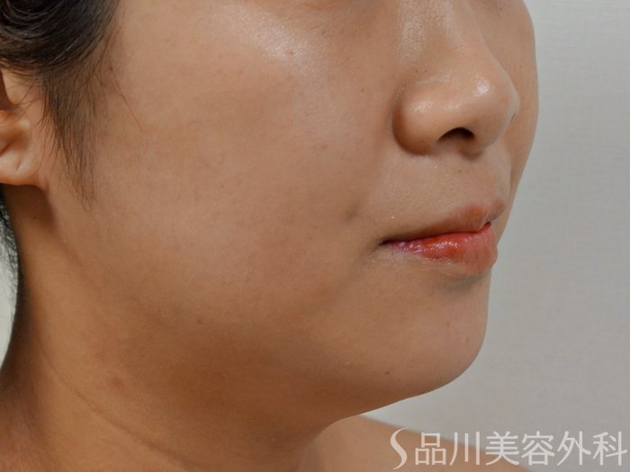 症例NO.73679のBEFORE写真