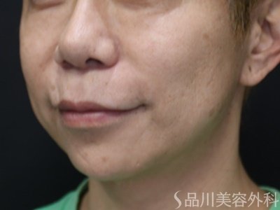 症例NO.74549のBEFORE写真