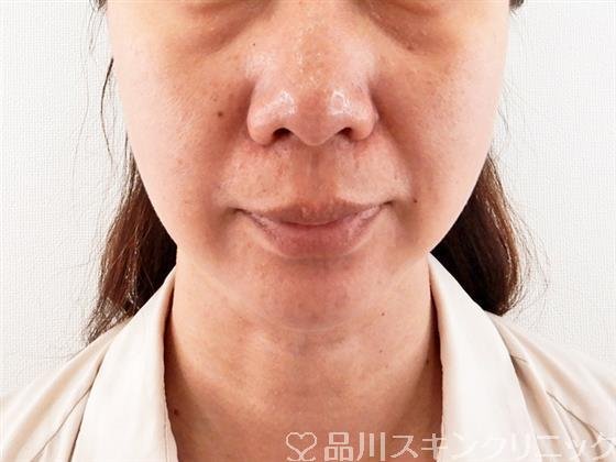 症例NO.61432のBEFORE写真