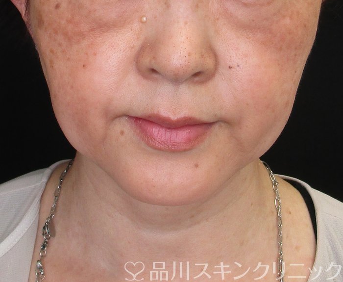 症例NO.74537のBEFORE写真