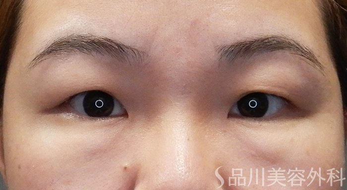 症例NO.71525のBEFORE写真