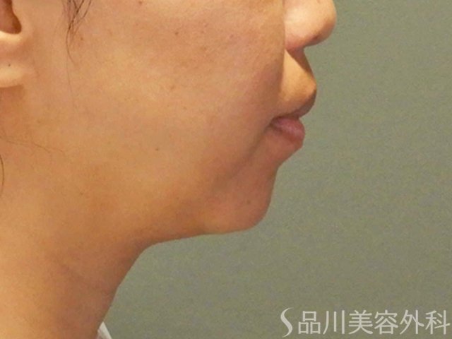 症例NO.66918のBEFORE写真
