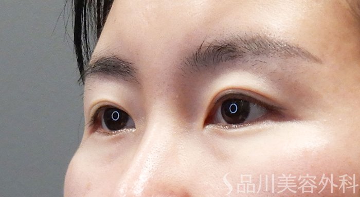 症例NO.69334のBEFORE写真