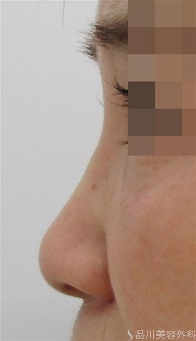 症例NO.44025のAFTER写真