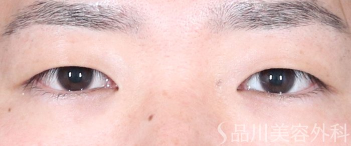 症例NO.74182のBEFORE写真