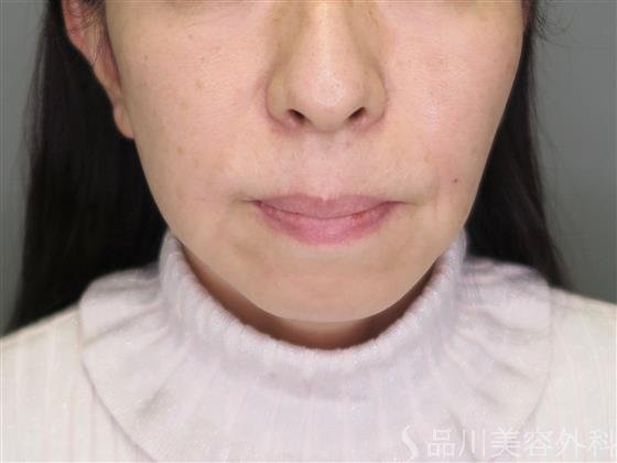 症例NO.49411のAFTER写真