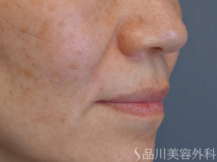 症例NO.72892のBEFORE写真