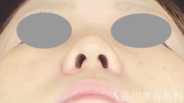 症例NO.67615のAFTER写真