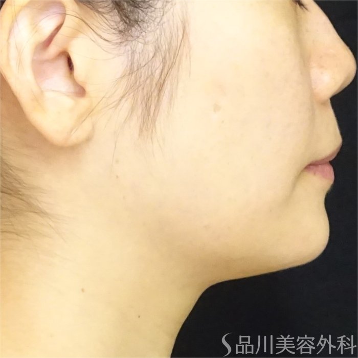 症例NO.69449のAFTER写真